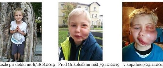 11-letni Rožle se že pet let bori s tumorjem