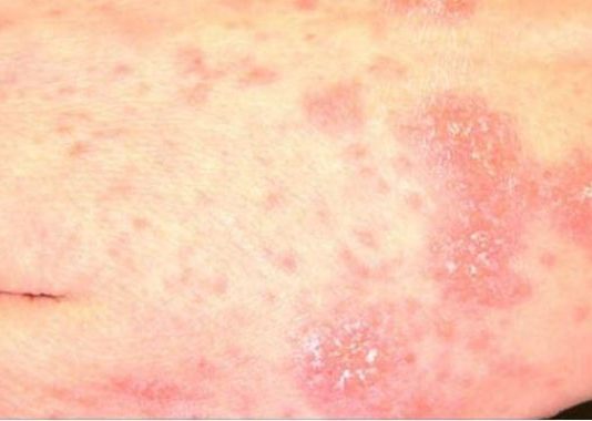 Novomeškega policista migranti okužili z garjami